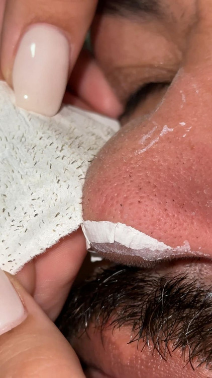 ماسک بینی جوش سرسیاه